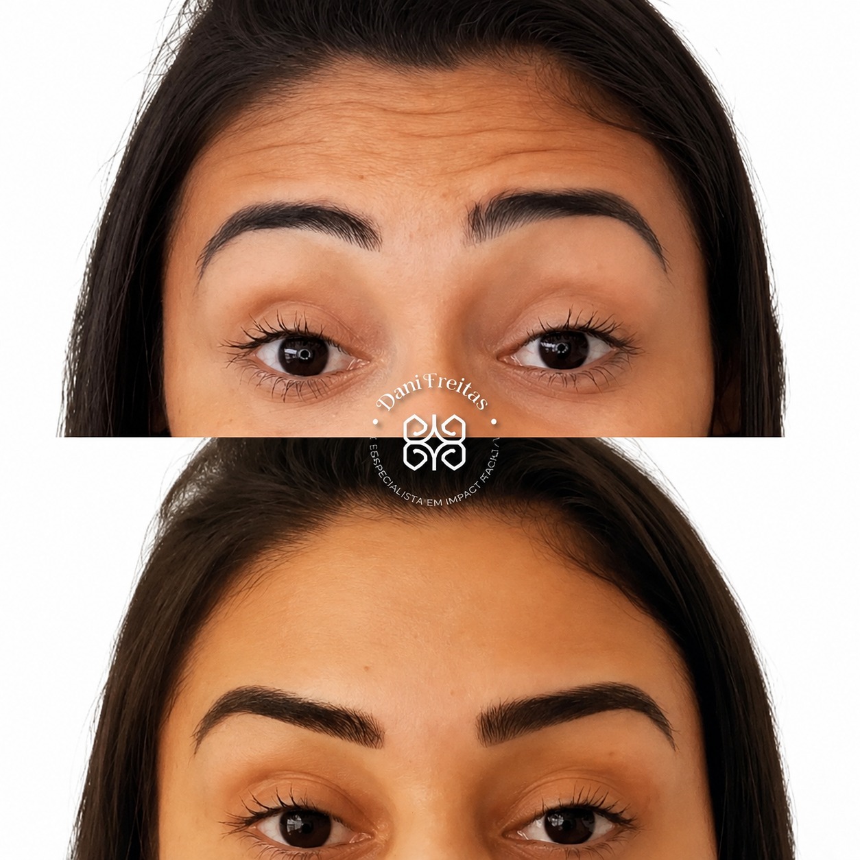 Antes e depois de aplicação de Botox na testa e glabela