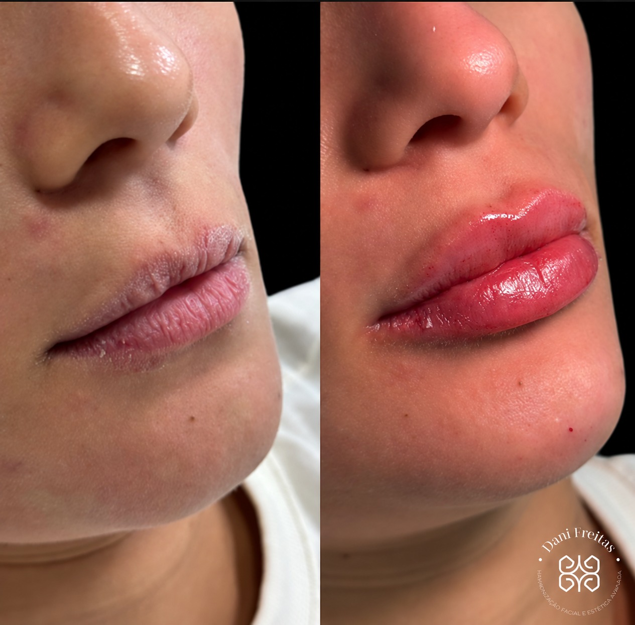 Antes e depois de preenchimento labial DF Lips realizado pela Dra. Dani Freitas